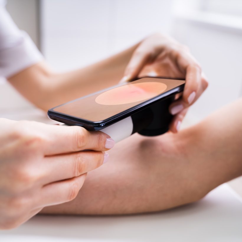 Waiting List Simulation of a Teledermoscopy Tool for Skin Cancer Screening​ – Open Medical